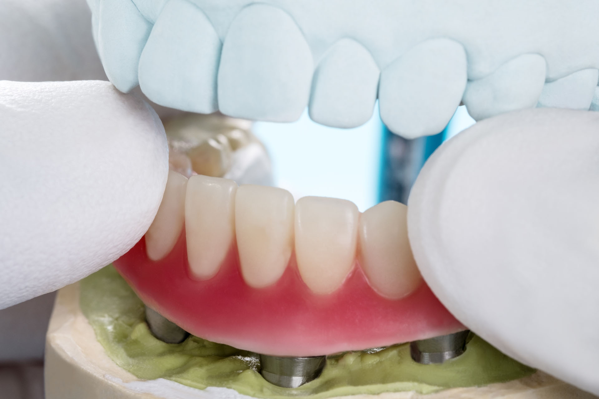 https://shifadentalperumpilavu.com/wp-content/uploads/2020/01/implant-supported-overdenture.jpg