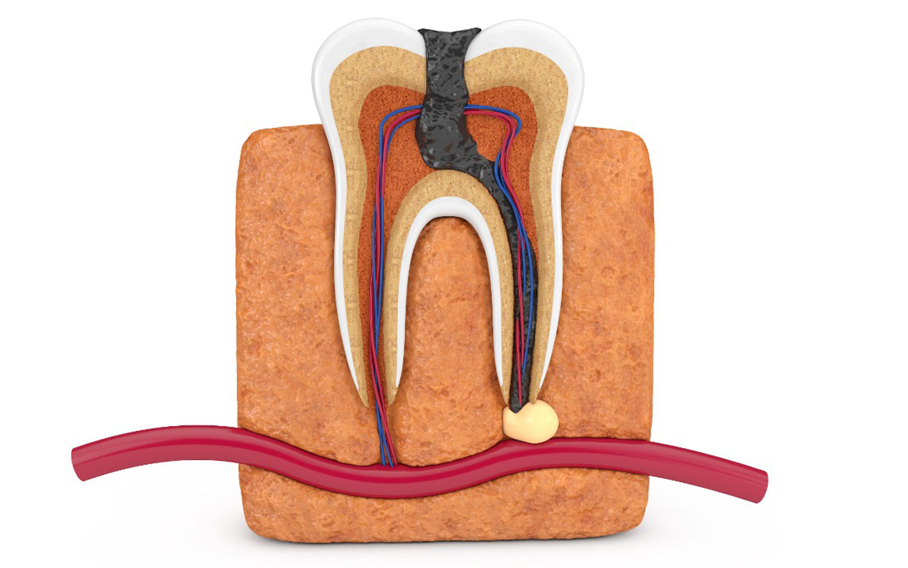 https://shifadentalperumpilavu.com/wp-content/uploads/2020/01/rootcanal_treatment_img.jpg