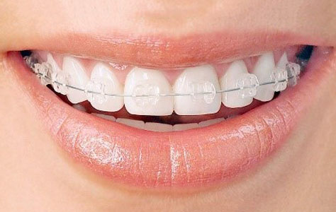 https://shifadentalperumpilavu.com/wp-content/uploads/2022/07/Ceramic_braces.jpg
