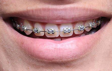 https://shifadentalperumpilavu.com/wp-content/uploads/2022/07/Traditional-Brace-1.jpg