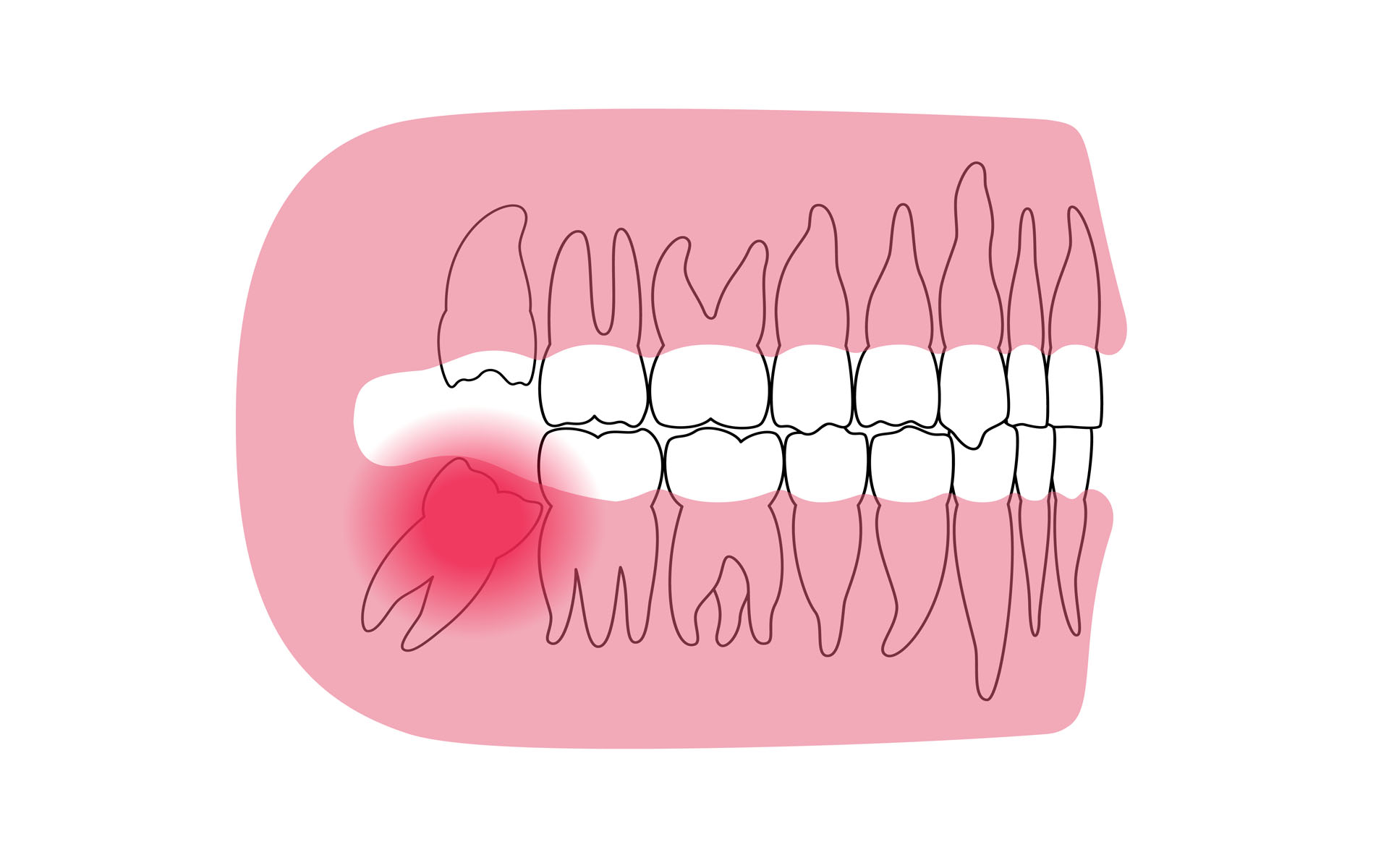 Impaction