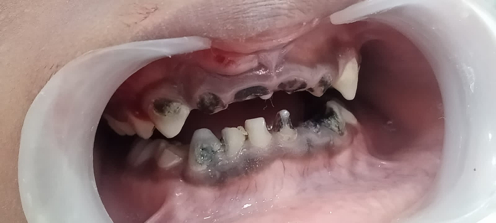 Nursing bottle caries