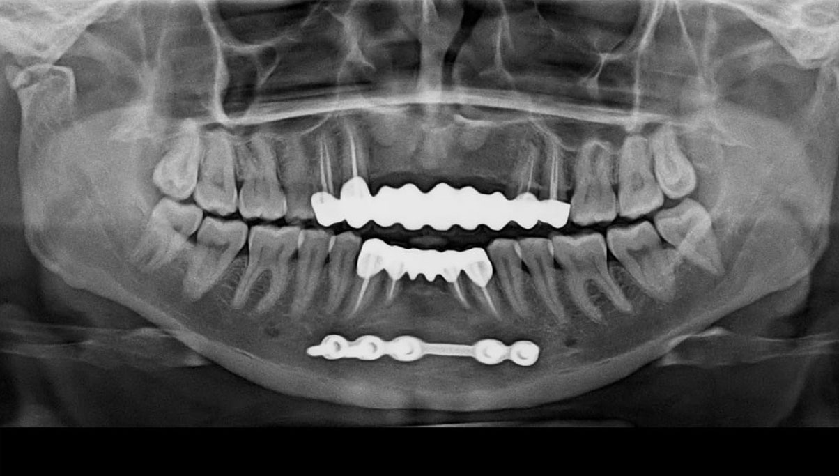 https://shifadentalperumpilavu.com/wp-content/uploads/2022/08/POST-OPERATIVE-OPG.jpg