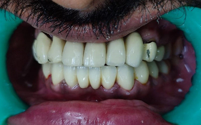 https://shifadentalperumpilavu.com/wp-content/uploads/2022/08/PRE-TREATMENT_img.jpg