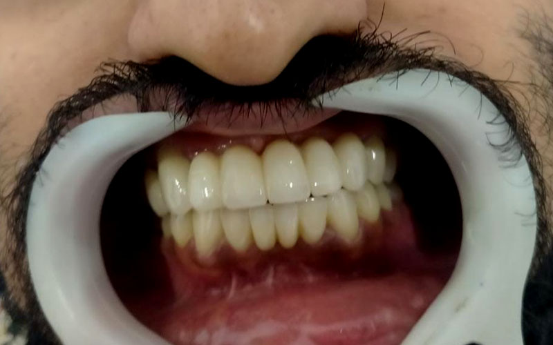 https://shifadentalperumpilavu.com/wp-content/uploads/2022/08/Post-TREATMENT_img.jpg