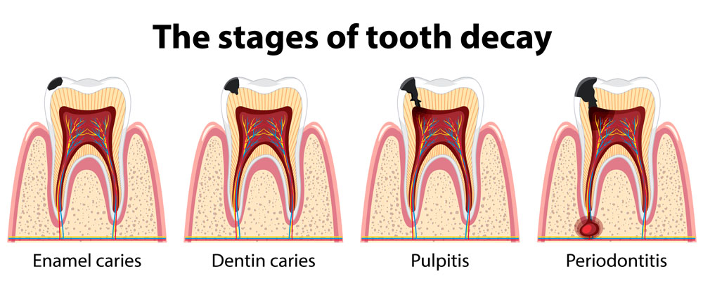 https://shifadentalperumpilavu.com/wp-content/uploads/2022/08/Tooth-Decay-Stages-1.jpg