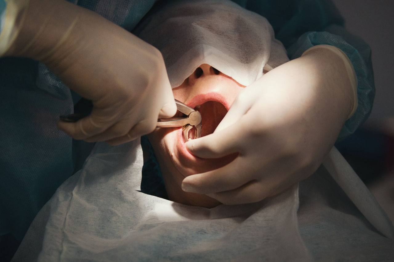 https://shifadentalperumpilavu.com/wp-content/uploads/2022/08/Tooth-removal_img1.jpg