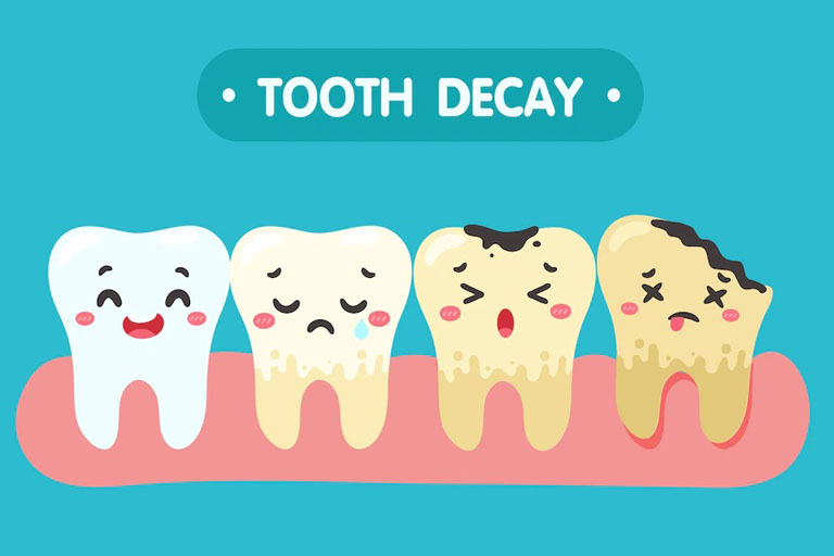 https://shifadentalperumpilavu.com/wp-content/uploads/2022/08/Tooth_-Decay.jpg