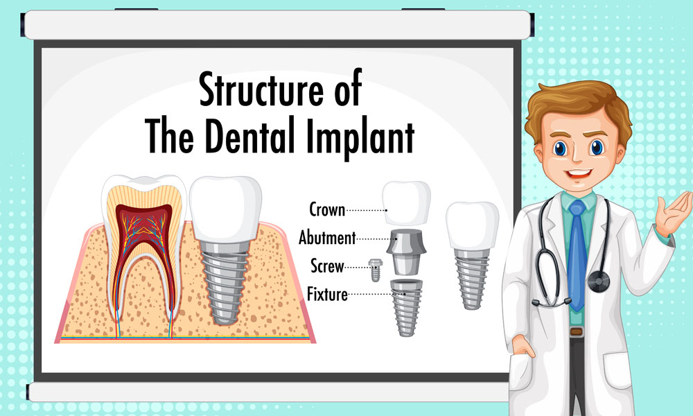 Implant prosthodontics