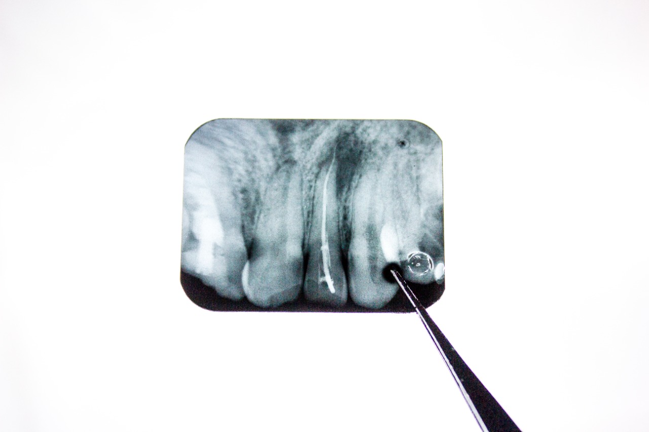 cyst-upper-jaw-pathological-formation