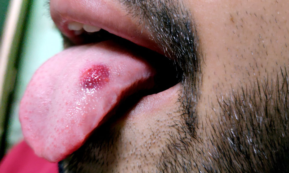 oral cancer Treatment
