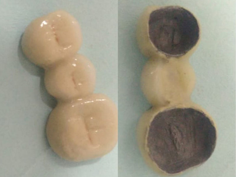 https://shifadentalperumpilavu.com/wp-content/uploads/2022/10/PORCELAIN-FUSED-TO-METAL-CROWNS-1.jpg