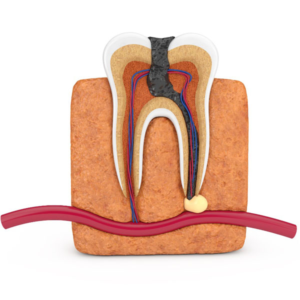https://shifadentalperumpilavu.com/wp-content/uploads/2022/10/ROOTcanal-therapy.jpg