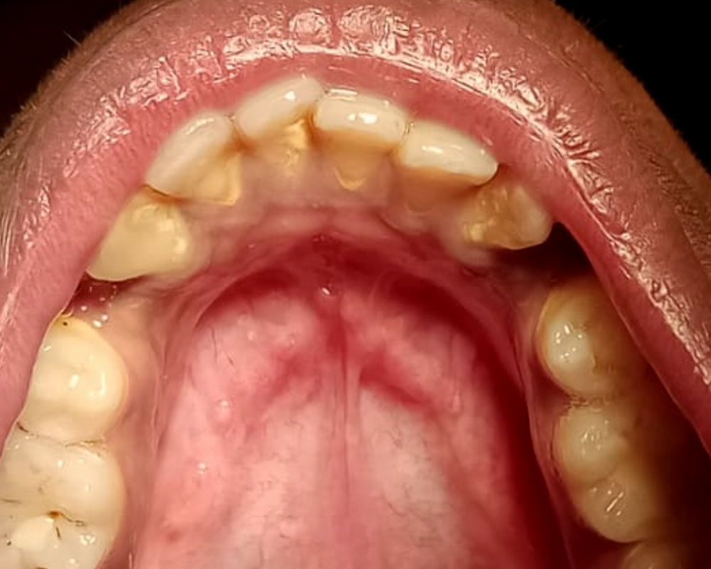 Teeth Cleaning - BEFORE