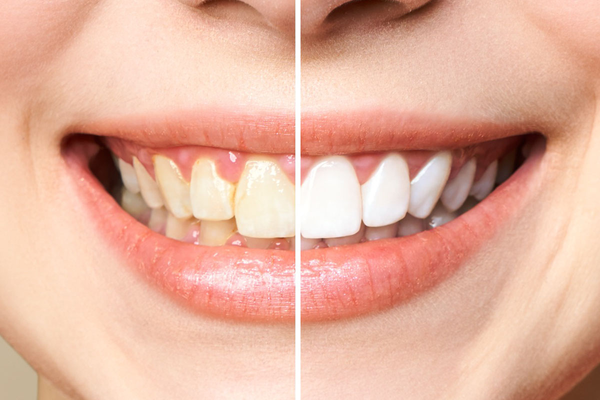 Teeth whitening https://shifadentalperumpilavu.com/wp-content/uploads/2022/10/Teeth-whitening.jpg