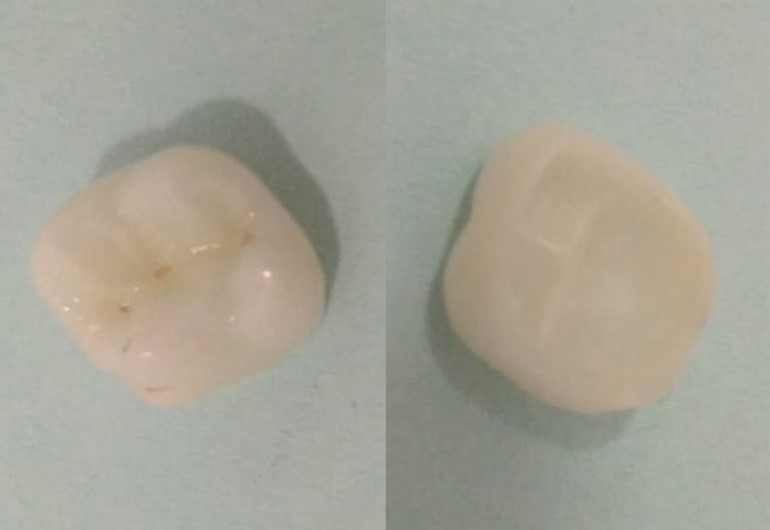 https://shifadentalperumpilavu.com/wp-content/uploads/2022/10/all-ceramic.jpg