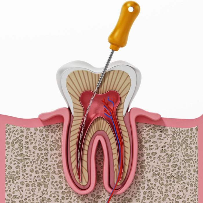 https://shifadentalperumpilavu.com/wp-content/uploads/2022/10/root_canal.jpg
