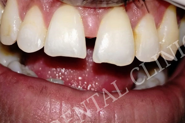 https://shifadentalperumpilavu.com/wp-content/uploads/2022/11/case3-a.jpg