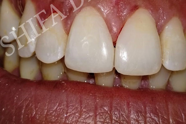 https://shifadentalperumpilavu.com/wp-content/uploads/2022/11/case3-b.jpg