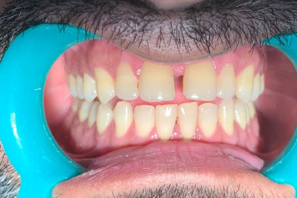 https://shifadentalperumpilavu.com/wp-content/uploads/2022/11/case4-a.jpg