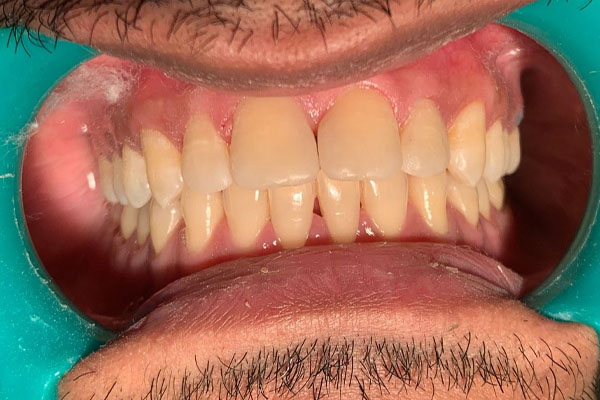 https://shifadentalperumpilavu.com/wp-content/uploads/2022/11/case4-b.jpg
