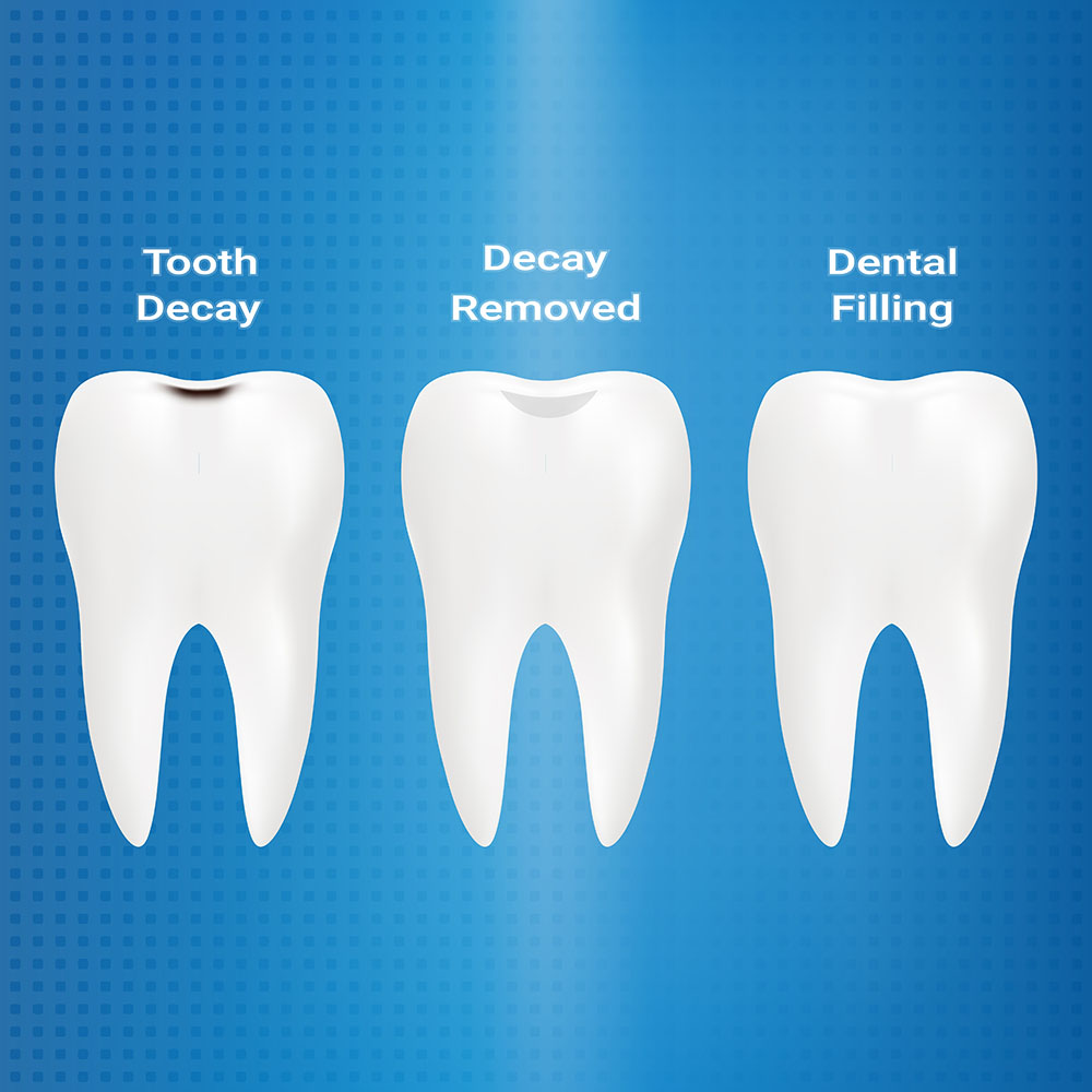 Treatment Of Caries. Dental Filling Isolated On A Background. Vector Illustration. Stomatology. Teeth And Tooth Concept Of Dental