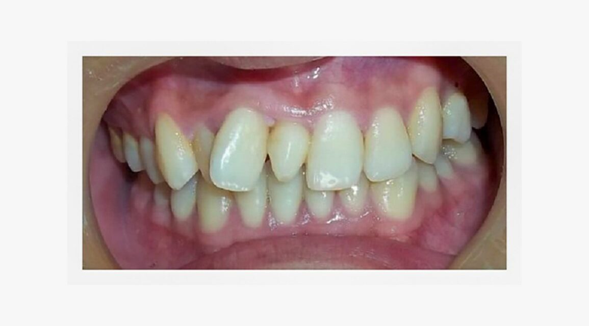 Mesiodens Causes and Treatment